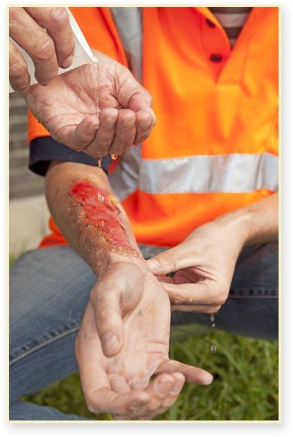 Worker with injury on their arm
